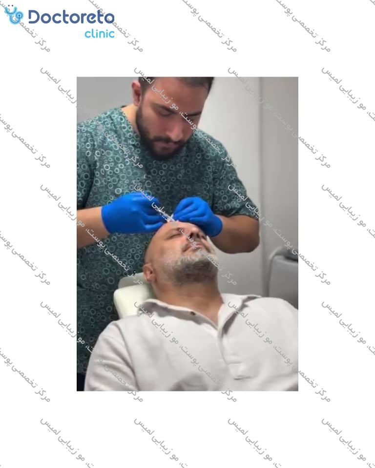 تزریق بوتاکس صورت (پیشانی، خط اخم، پنجه کلاغی)💉
