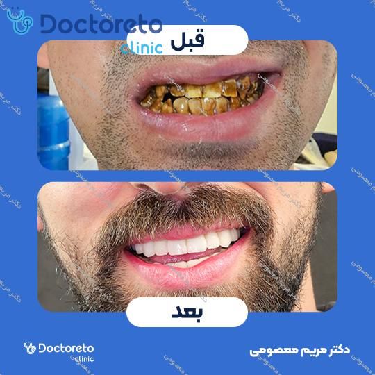 روکش دندان (هر واحد)