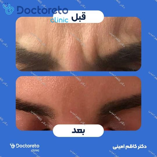 تزریق بوتاکس صورت (پیشانی، خط اخم، پنجه کلاغی)💉