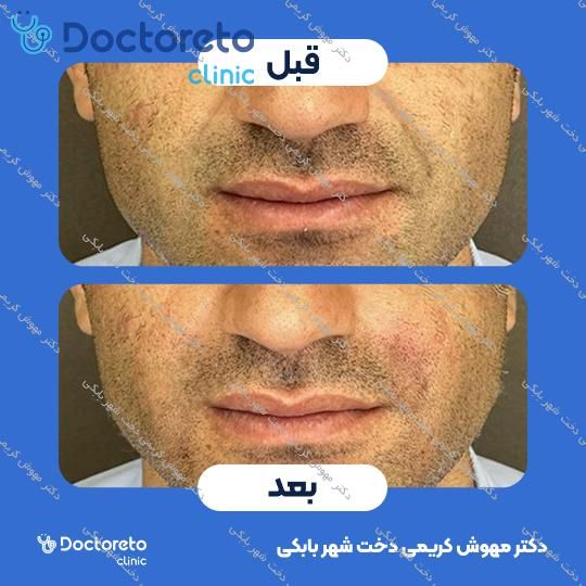 تزریق ژل خط خنده