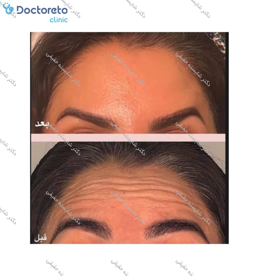 تزریق بوتاکس صورت (پیشانی، خط اخم، پنجه کلاغی)💉