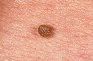 برداشتن زگیل تناسلی بانوان (هر عدد)