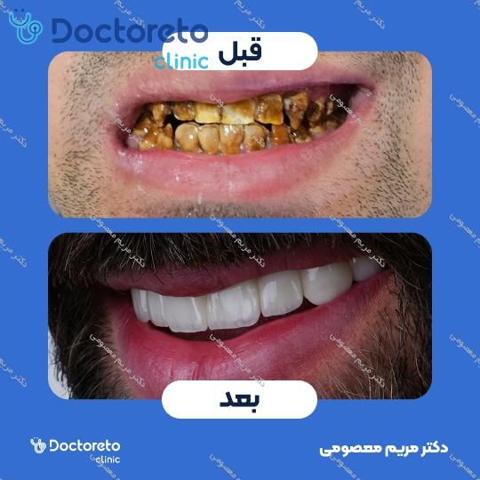 روکش دندان (هر واحد)