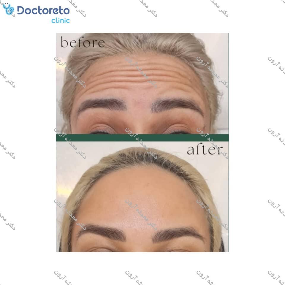 تزریق بوتاکس صورت (پیشانی، خط اخم، پنجه کلاغی)💉