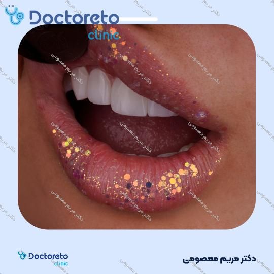 ونیر کامپوزیت (هر واحد)