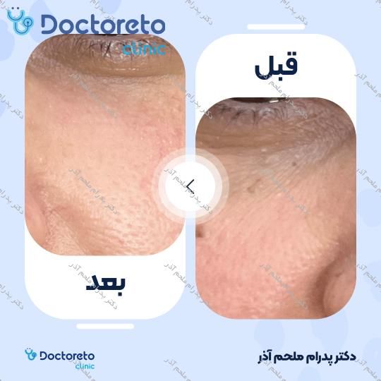 تزریق ژل زیرچشم