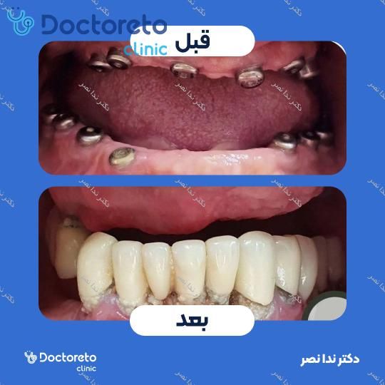 ایمپلنت دندان با روکش (هر واحد)