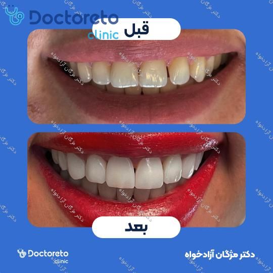 کامپوزیت دندان (هر واحد)