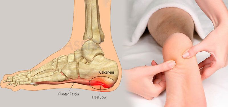 فزیوتراپی تخصصی خار پاشنه و درد های کف پا با شاک ویو