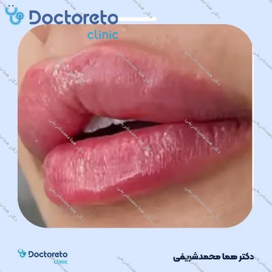 تزریق ژل لب