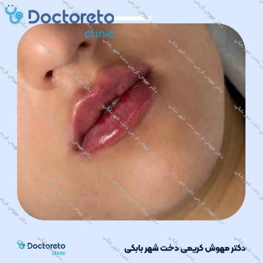 تزریق ژل لب