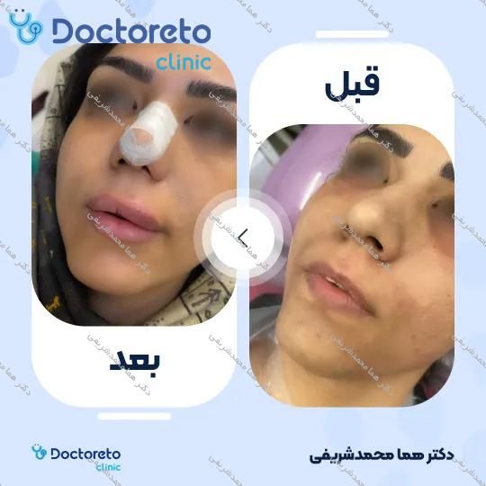 تزریق ژل لب