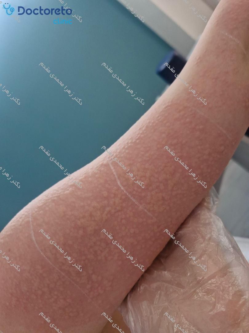 لیزر موهای زائد با دستگاه کندلا⚡