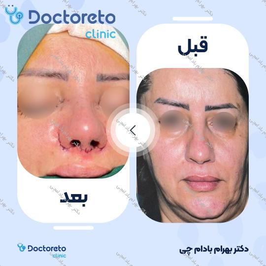 عمل زیبایی بینی گوشتی (رینوپلاستی)