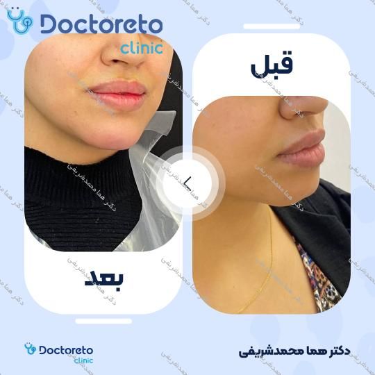 تزریق ژل چانه