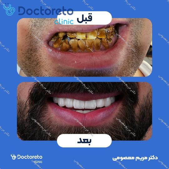 روکش دندان (هر واحد)