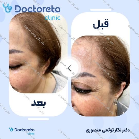 تزریق بوتاکس صورت (پیشانی، خط اخم، پنجه کلاغی)💉