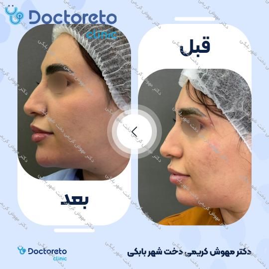 تزریق ژل چانه