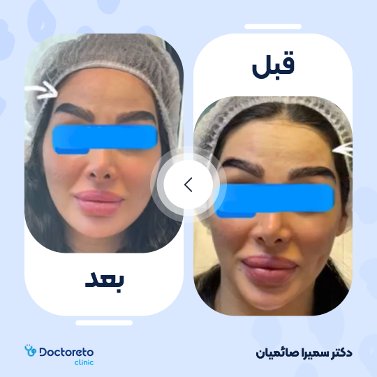 تزریق بوتاکس صورت (پیشانی، خط اخم، پنجه کلاغی)💉