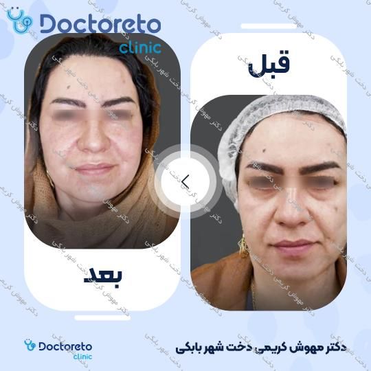 تزریق ژل خط خنده