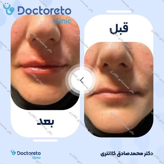 تزریق ژل لب