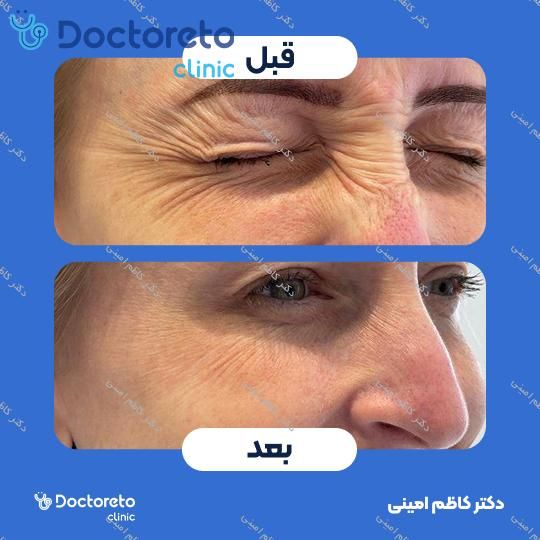 تزریق بوتاکس صورت (پیشانی، خط اخم، پنجه کلاغی)💉