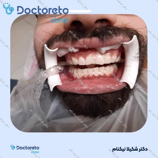 بلیچینگ دندان (سفید کردن دندان)