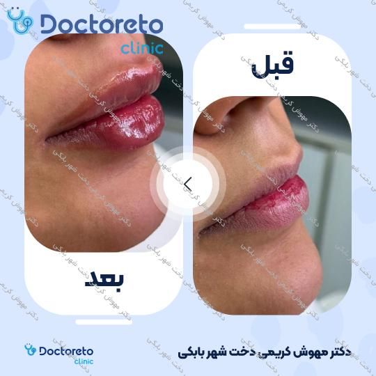 تزریق ژل لب