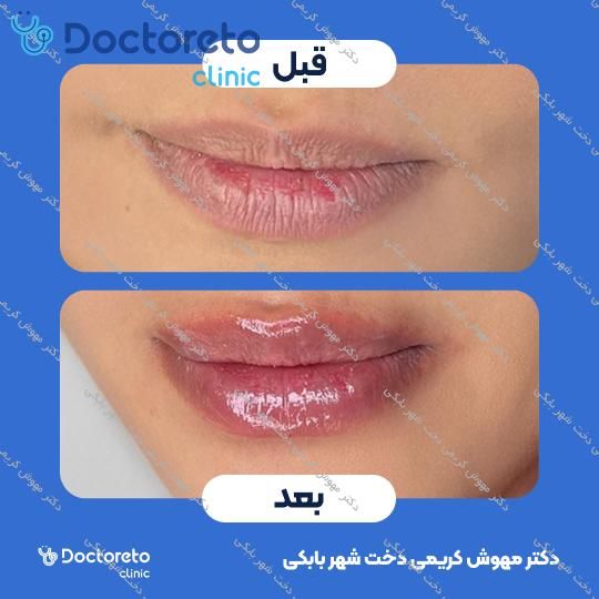 تزریق ژل لب