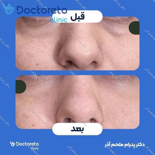 تزریق ژل زیرچشم