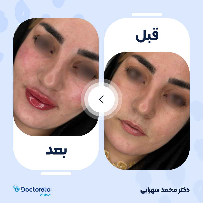 تزریق ژل لب