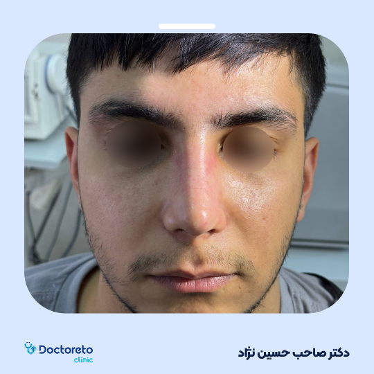 عمل جراحی مجدد زیبایی بینی (رینوپلاستی)