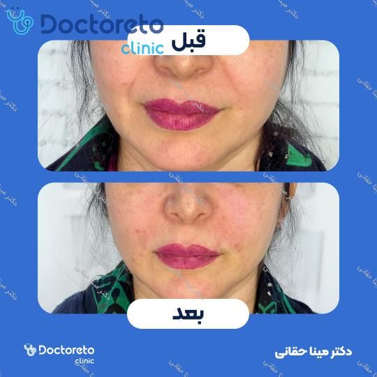 تزریق ژل خط خنده با برند سیتوسیال (1CC)