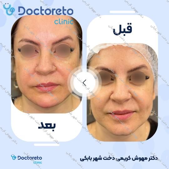 تزریق ژل خط خنده