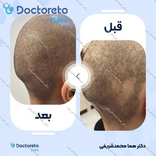 جوانسازی و روشن سازی سیاهی دور چشم با روش پلاسما تراپی