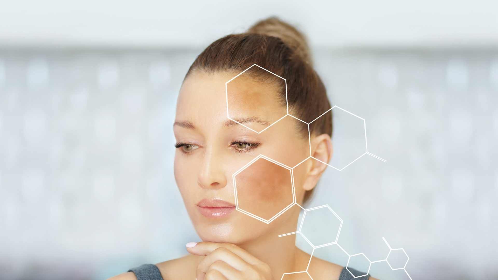 رفع کک و مک صورت با دستگاه لیزر نابوی (هر جلسه)