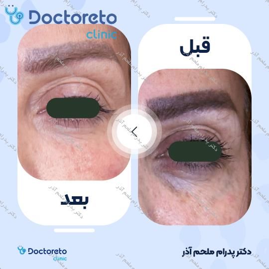 تزریق ژل زیرچشم