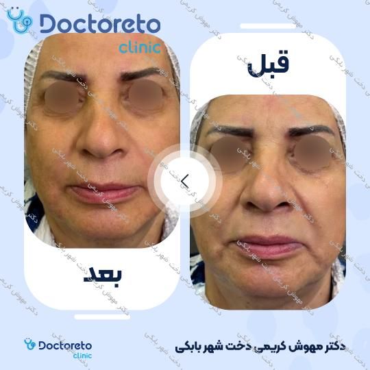 تزریق ژل خط خنده