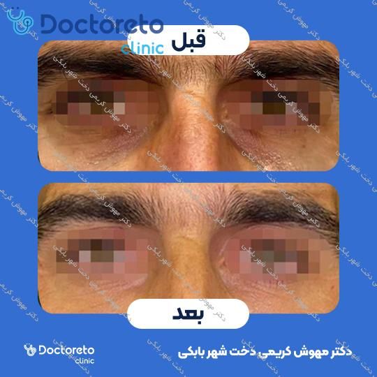 تزریق ژل زیر چشم