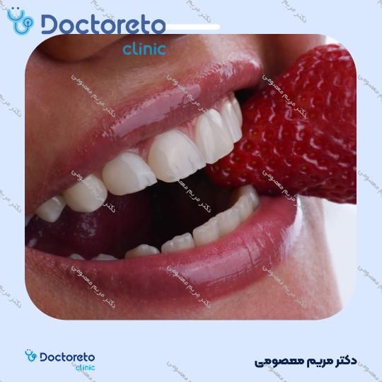 ونیر کامپوزیت (هر واحد)