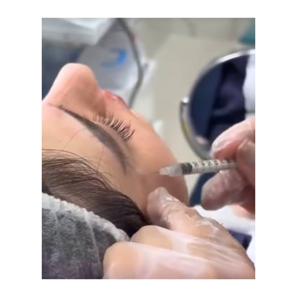 تزریق بوتاکس صورت (پیشانی، خط اخم، پنجه کلاغی)💉