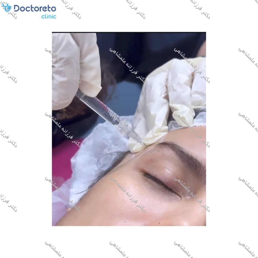 تزریق بوتاکس صورت (پیشانی، خط اخم، پنجه کلاغی)💉