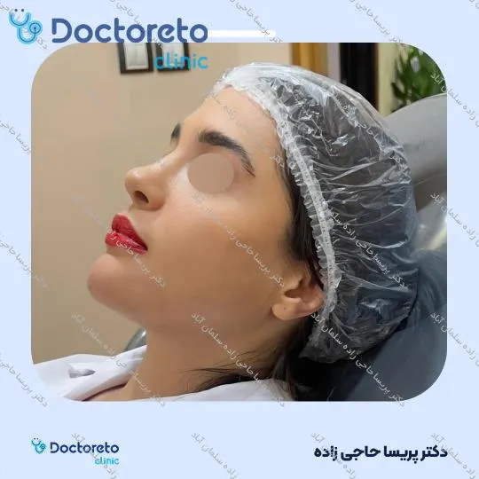 تزریق ژل خط خنده