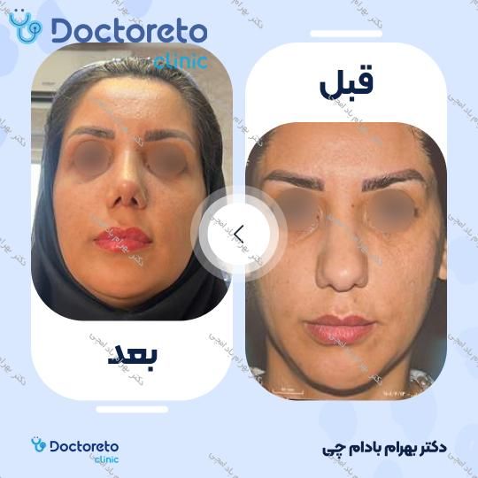 عمل زیبایی بینی گوشتی (رینوپلاستی)