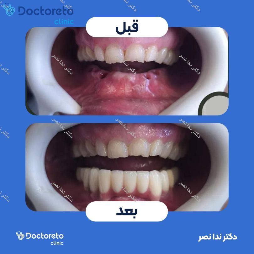 ایمپلنت دندان با روکش (هر واحد)