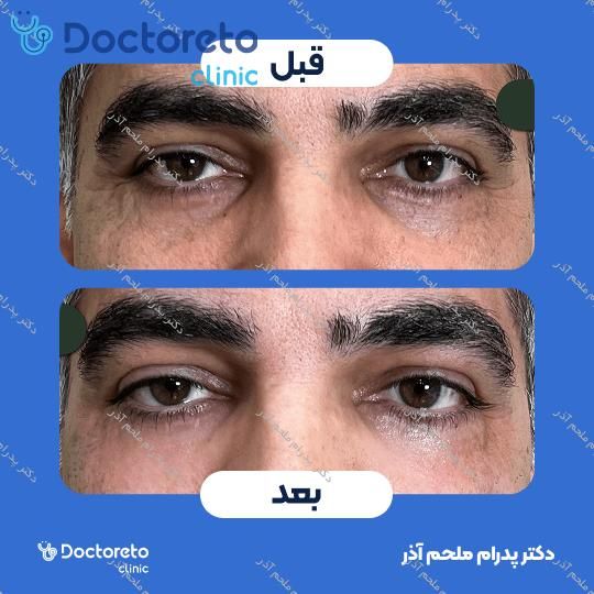 تزریق ژل زیرچشم