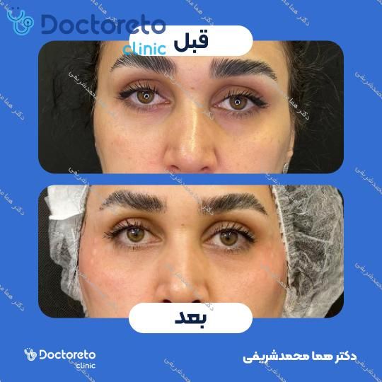 تزریق ژل زیرچشم