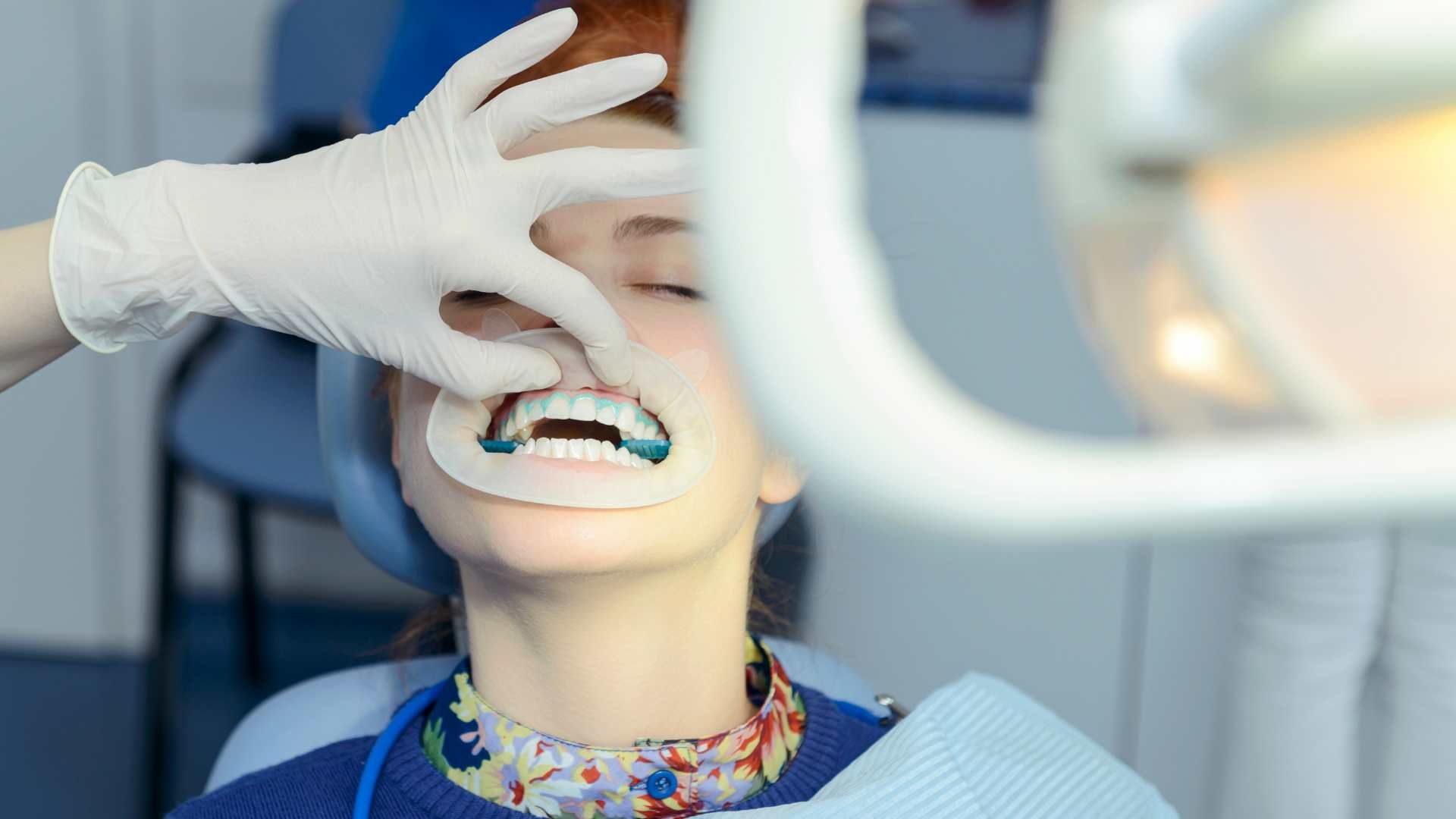 آفیس بلیچینگ (سفید کردن دندان) دو فک