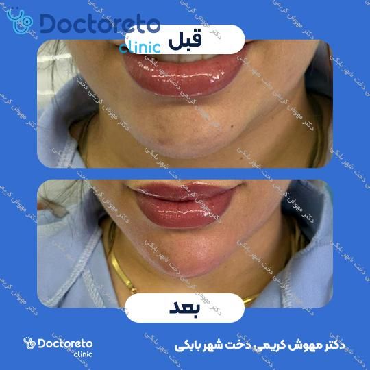 تزریق ژل چانه