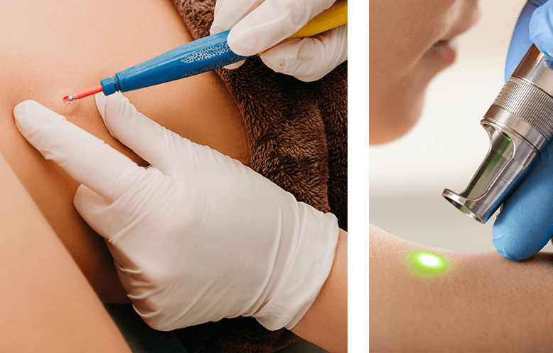 برداشتن زگیل تناسلی آقایان